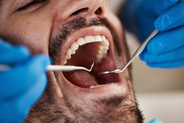 Best Urgent Care for Lost Fillings or Crowns in Kitsap Lake, WA